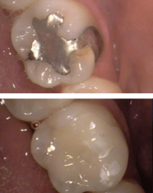 Replacement of Metal Fillings with Porcelain Onlay Before After