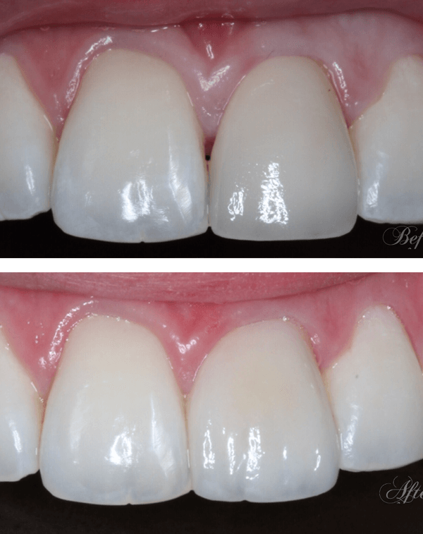 Porcelain Crown Replacement with Custom Staining Before After