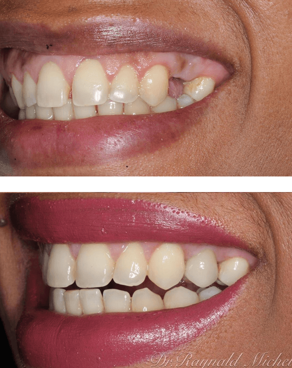 Dental Implants Before After