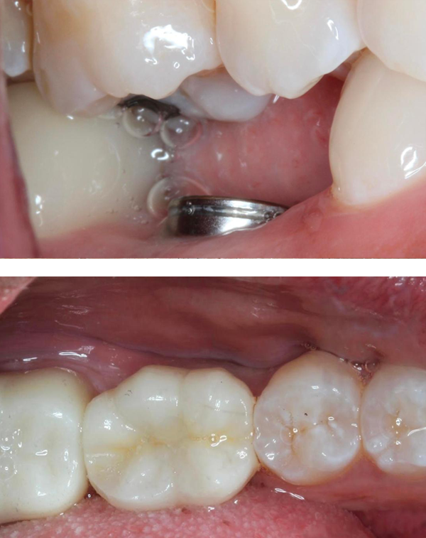 Replacement of a missing molar tooth with a dental implant Before After