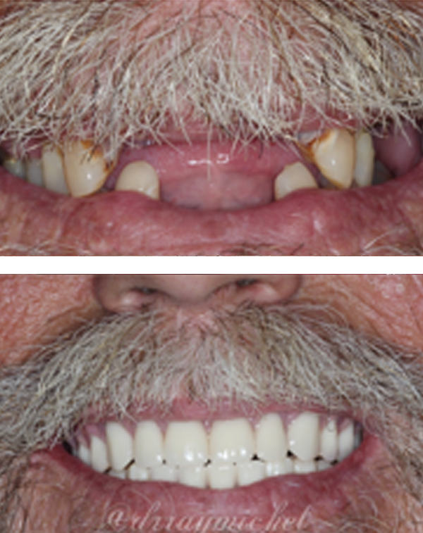 Full Mouth Extraction and Complete Immediate Denture Fabrication Before After