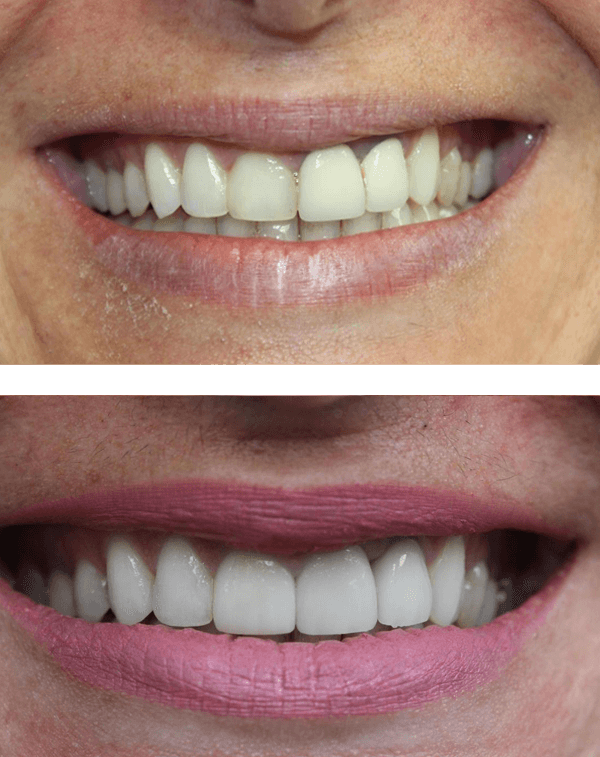 Crown revision/replacement Before After