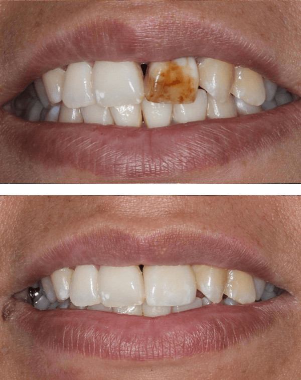 Dental Implant Before After Case 02