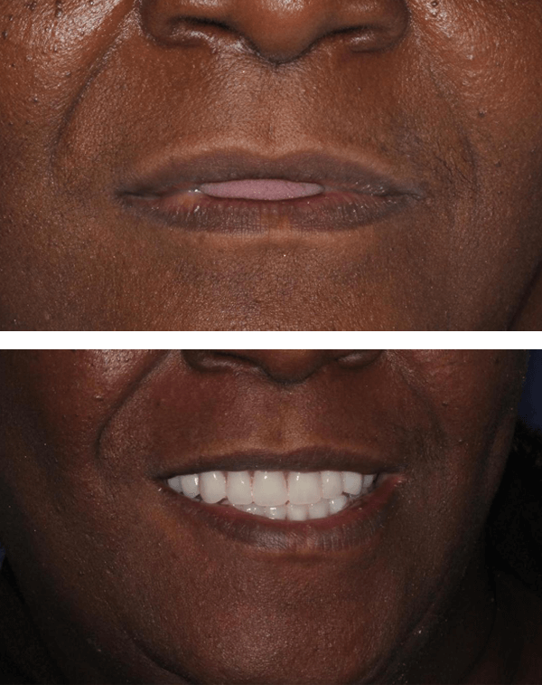 Implant Overdenture Before After