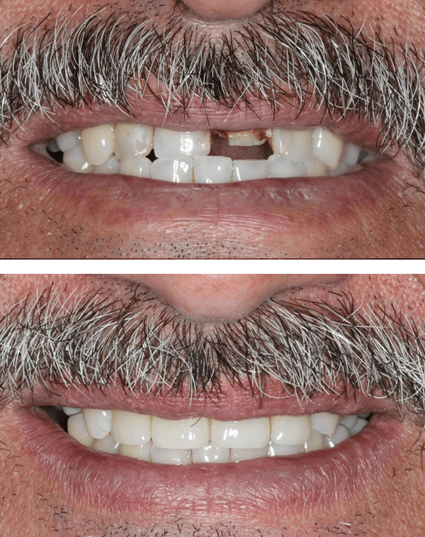 Porcelain Crowns Before After