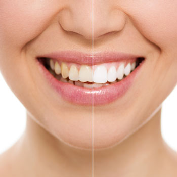 Teeth Whitening Before After