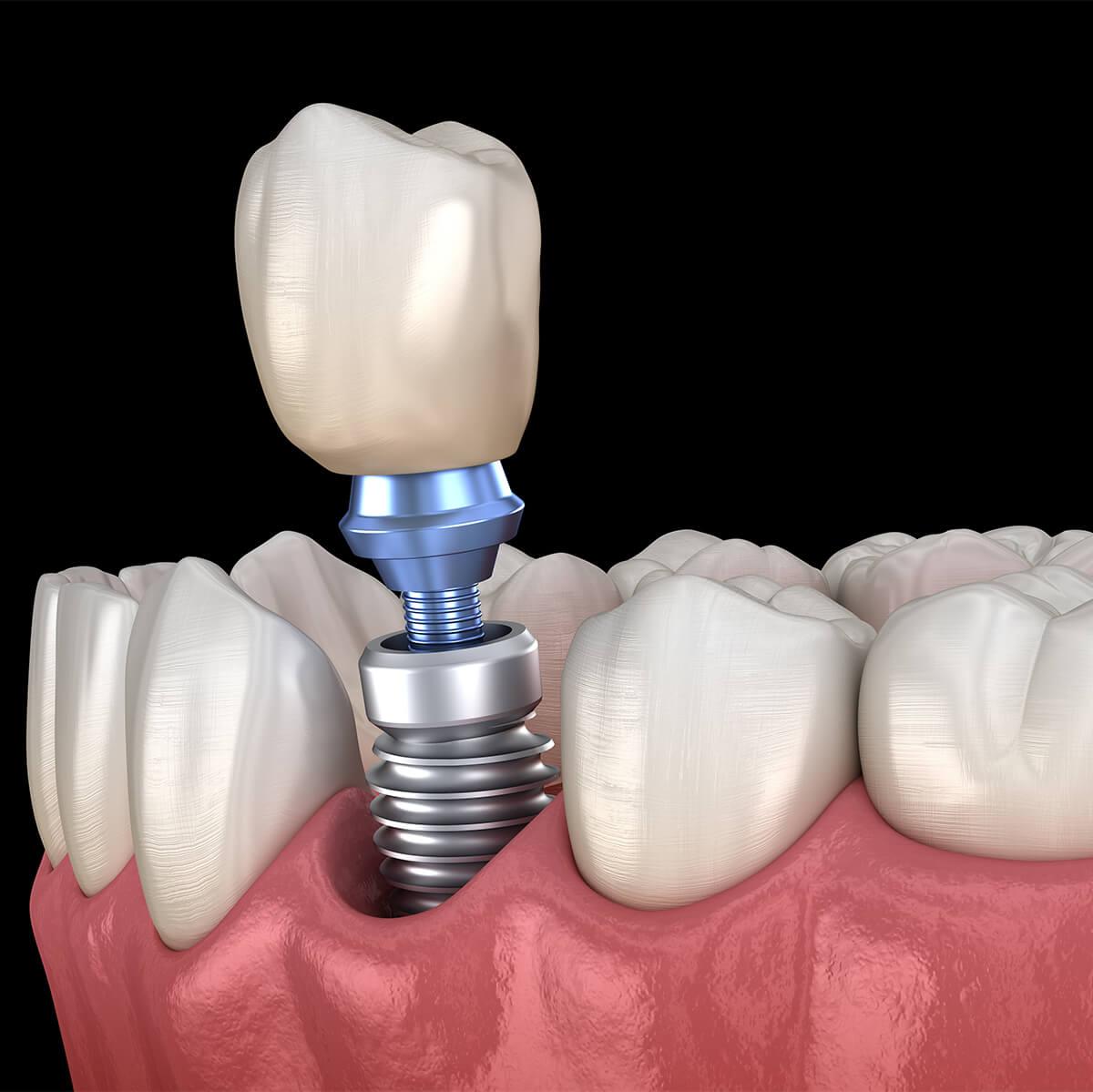 Tooth Implant Procedure in Lauderdale FL Area