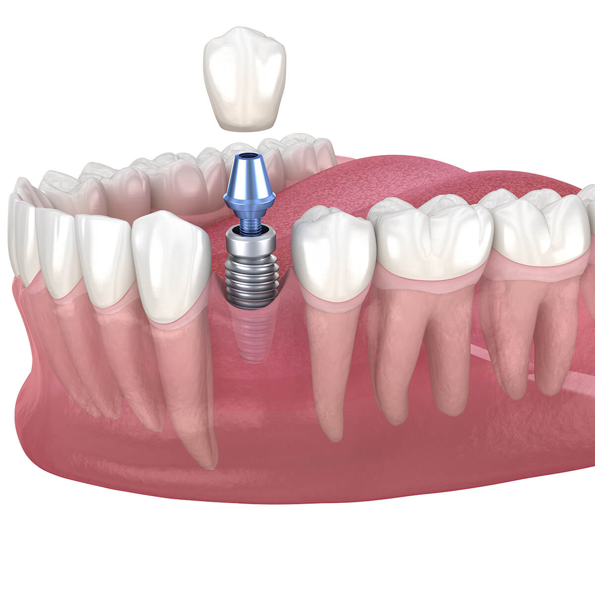 Find an Implant Dentist Near Me Fort Lauderdale FL Area