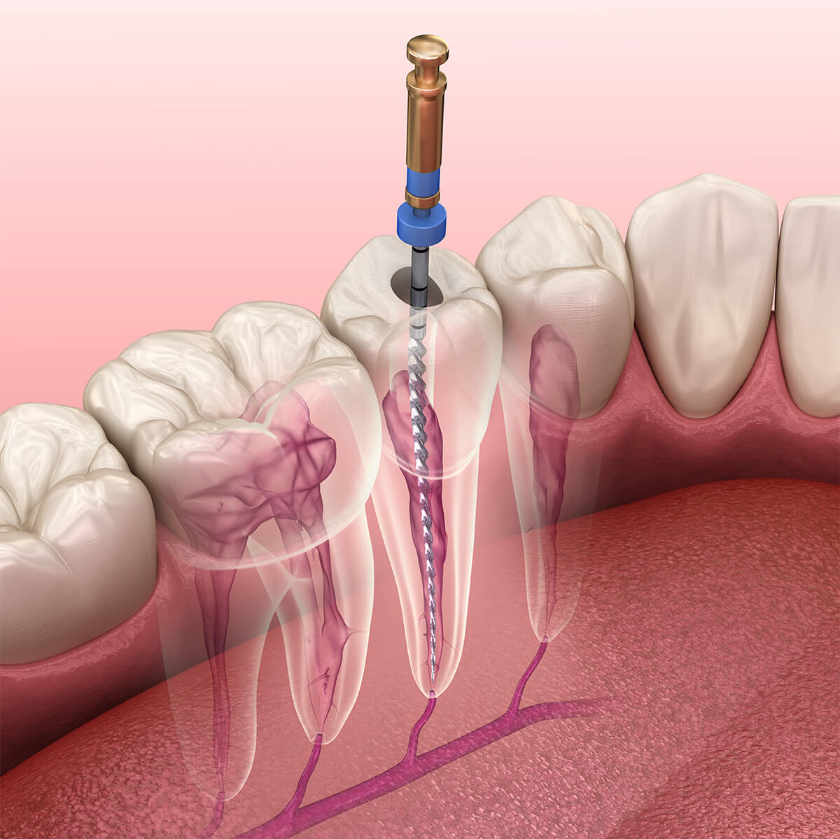 Process for a Root Canal in Fort Lauderdale FL Area