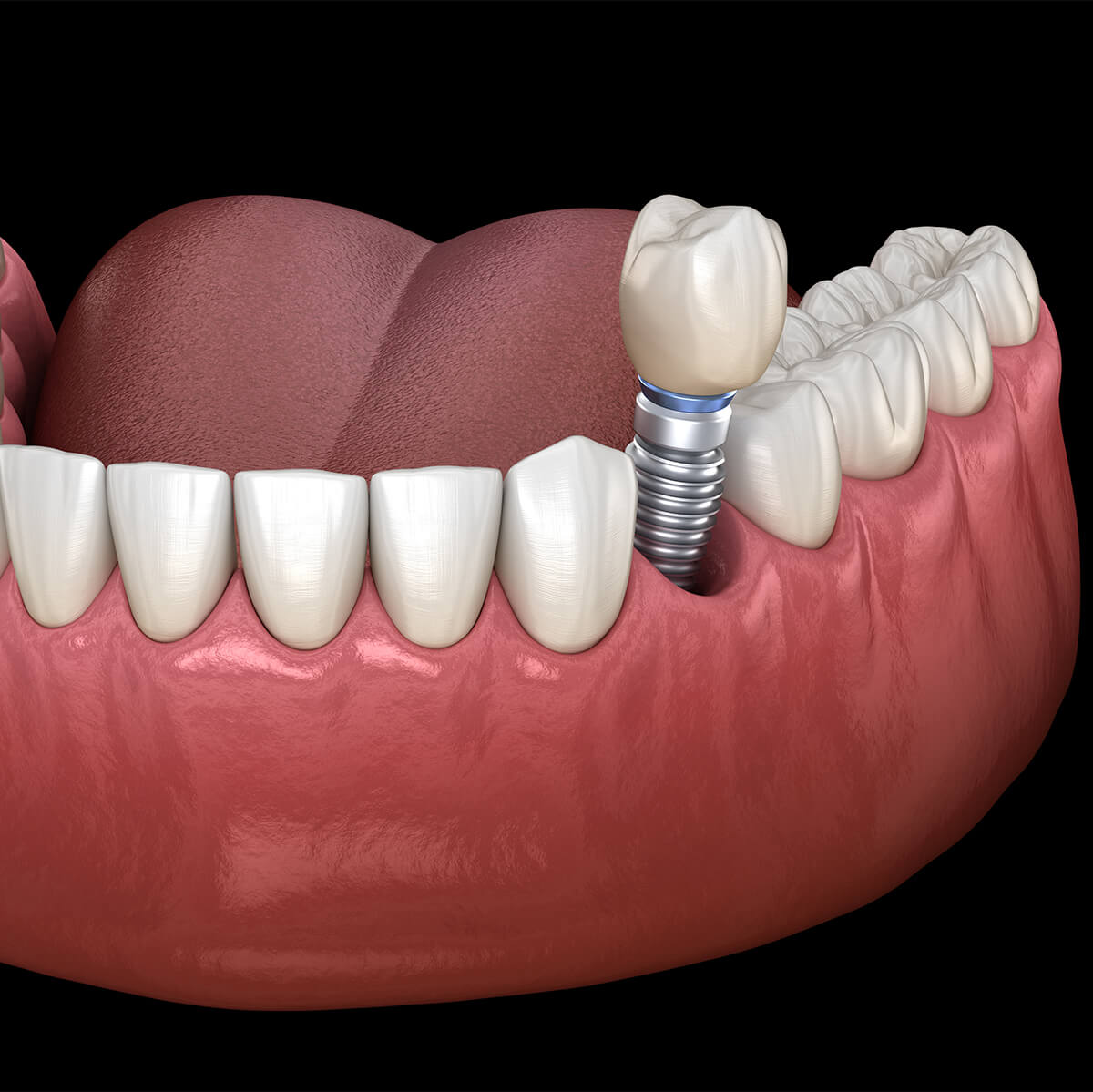 Types of Dental Implants in Fort Lauderdale FL Area